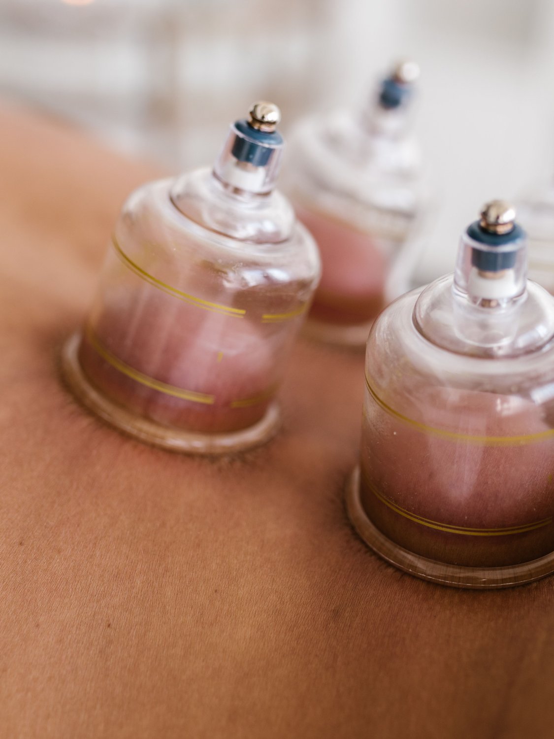 Cupping therapy cups placed on the back during a session